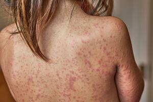 PAHO: Epidemija malih boginja se pogoršava u Sjevernoj Americi, 18...