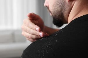 Napravite domaći šampon protiv peruti