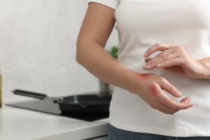 Prva pomoć kod manjih opekotina u kuhinji