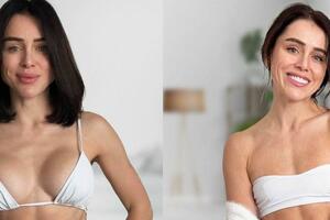 Zašto sve više žena uklanja silikone iz grudi