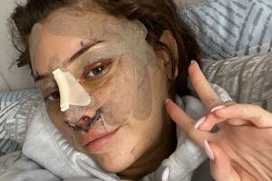 Zatezanje lica u 28. godini: Mladi se okreću plastičnoj hirurgiji