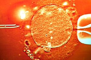 Skoro 200 djece začeto spermom davaoca sa genetskom mutacijom koja...