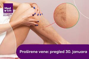 Proširene vene: kada bol i otok postaju signal za pregled?