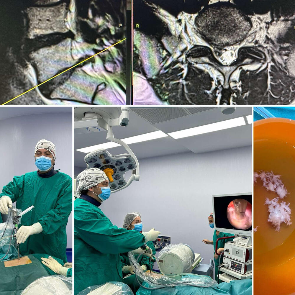 Codra Hospital A revolution in spine treatment in Podgorica - Minimally invasive ...