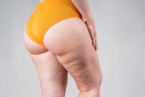 Celulit: Mala udubljenja, veliki problemi i još veća zarada